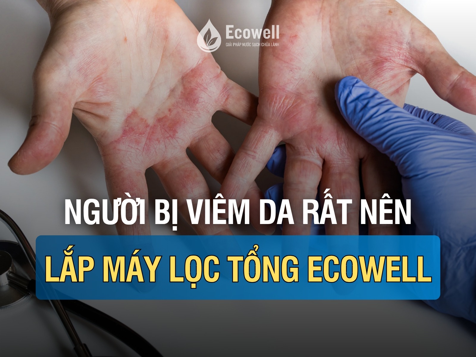 Người bị viêm da, dị ứng mãn tính nên dùng máy lọc tổng Ecowell thế nào để cải thiện tình trạng da?