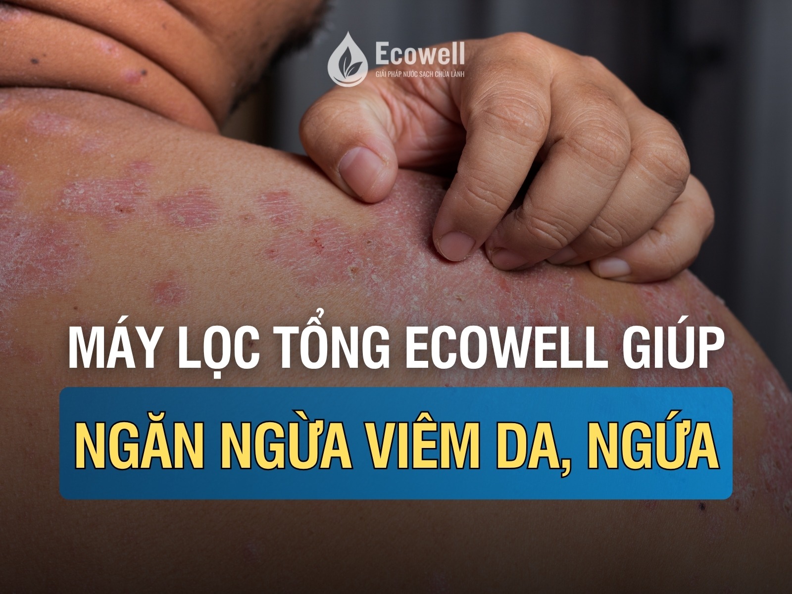 Máy lọc nước tổng Ecowell có giúp ngăn ngừa viêm da, mẩn ngứa khi tắm nước máy không?