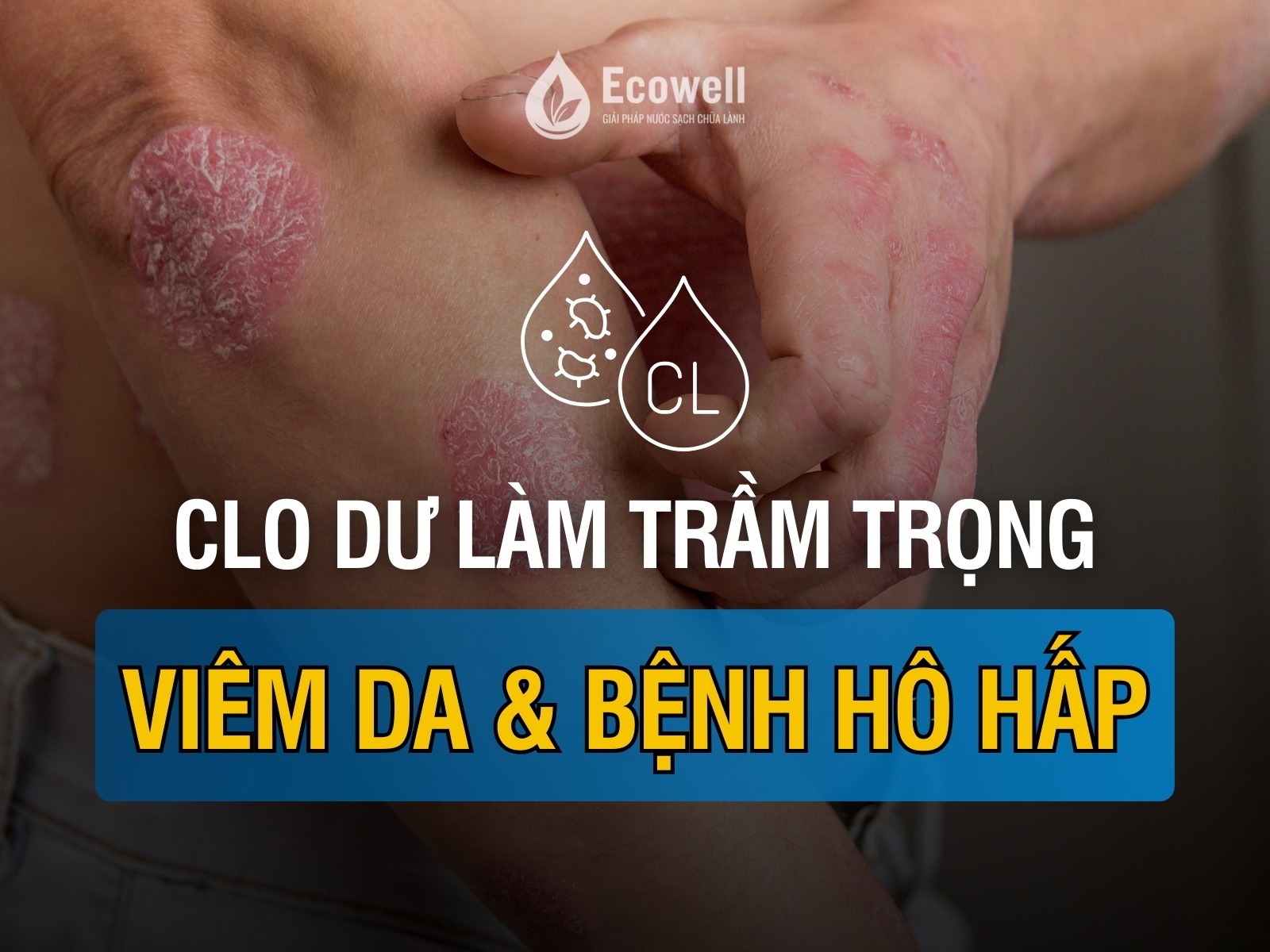 Clo dư: Thủ phạm khiến viêm da và bệnh hô hấp trầm trọng hơn?